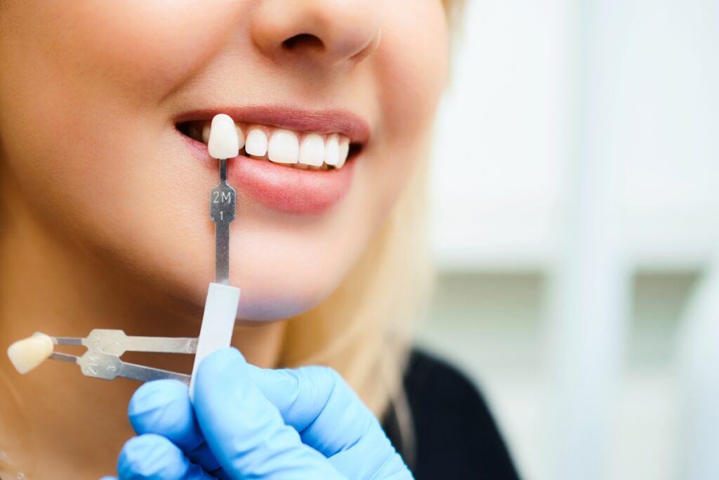 Dental implant shade matching for a natural-looking smile.