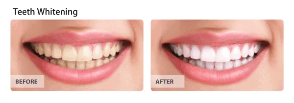 whitening